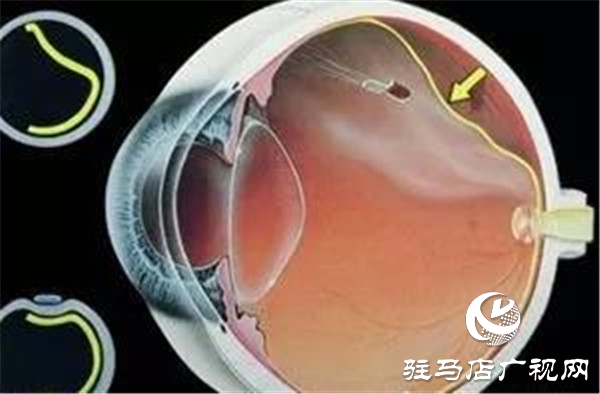 一只眼睛視網膜脫落，另一只也會脫落嗎