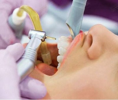 洗牙是“智商稅”還是護(hù)牙必備？專家揭秘真相