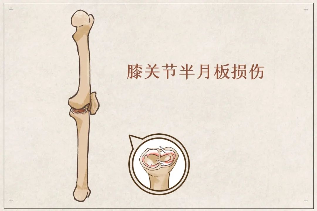 盲目鍛煉？你的半月板傷不起