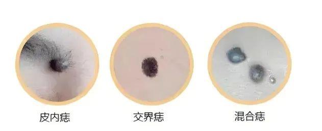 危險的痣長啥樣？“ABCDE法則”教你辨別