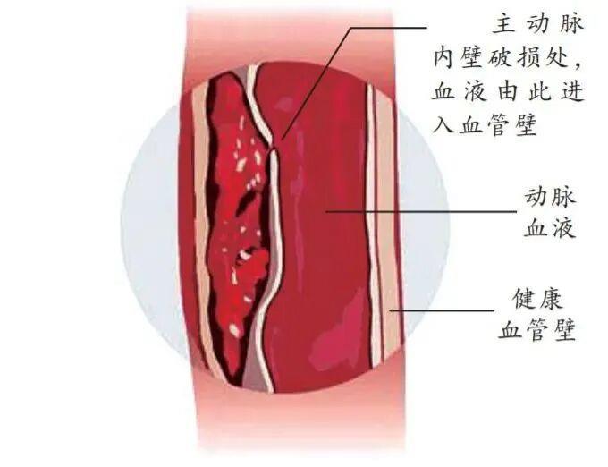 防寒更要防病！醫(yī)生提醒：別讓低溫“凍”破主動(dòng)脈
