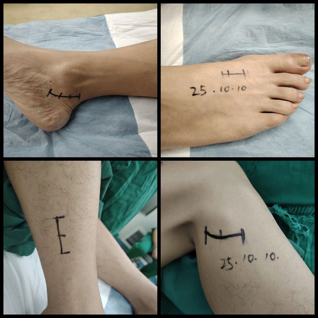 腦外科成功開(kāi)展周圍神經(jīng)減壓術(shù)，為糖尿病患者解除病痛困擾