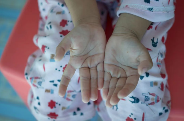 關(guān)于手足口病的8個(gè)常見誤區(qū)，一次說(shuō)清！