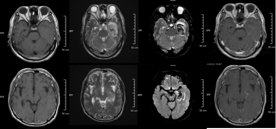 30歲小伙長(zhǎng)期熬夜智力退回3歲 年輕人患“腦膜炎”病例為何頻發(fā)？